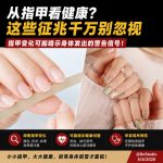 别再忽略指甲！这些异常可能和健康有关